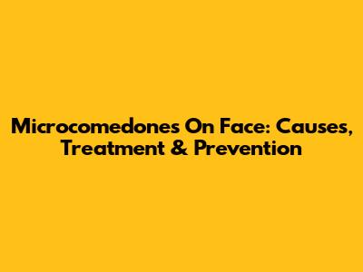 Microcomedones On Face: Causes, Treatment & Prevention